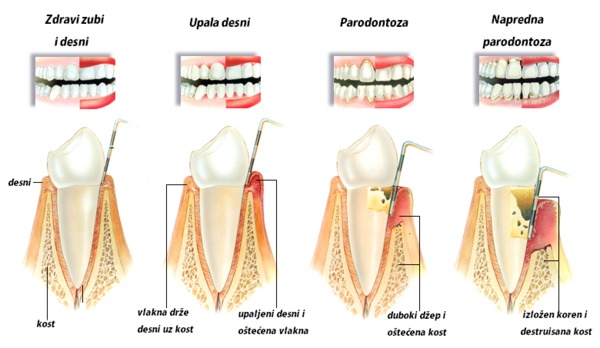 obrada parodontalnog dzepa