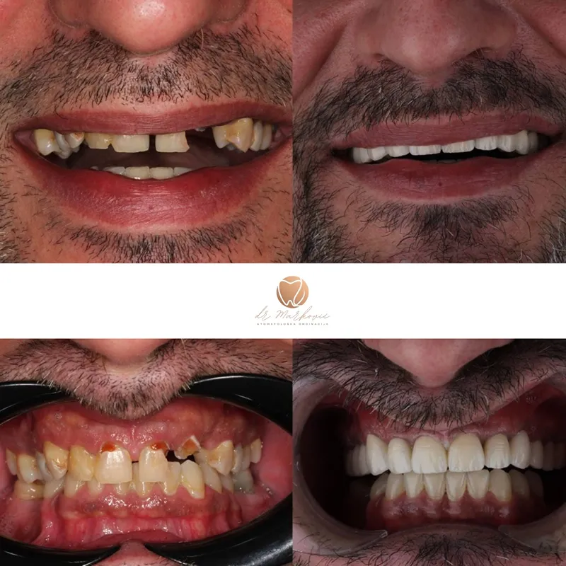 Transformacija osmijeha – fotografija 2