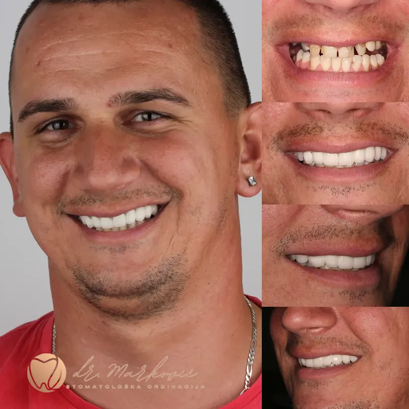 Transformacija osmijeha – fotografija 24