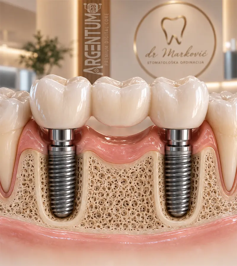 Most oslonjen na zubne implantate